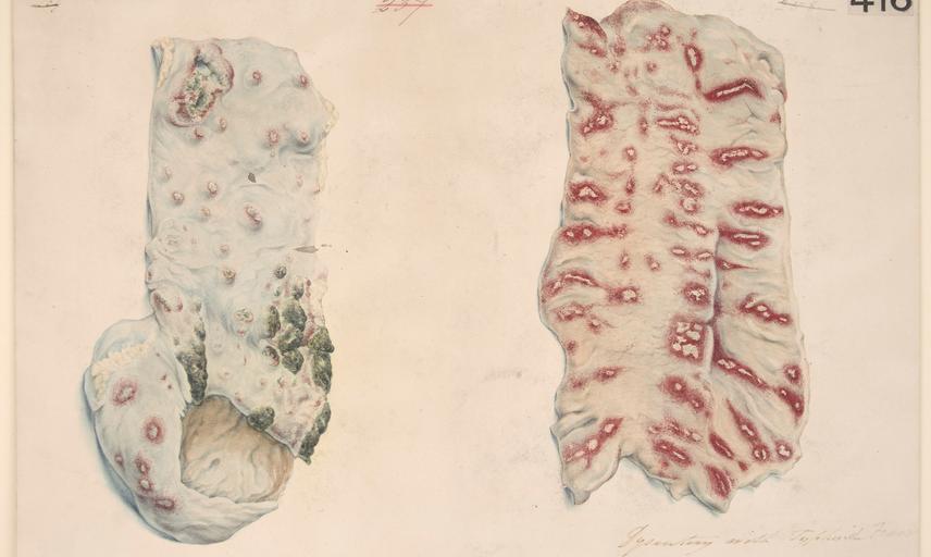 Wellcome Collection - watercolour drawing of two portions of the intestines illustrating the morbid effects of a case of dysenter with typhoid fever.